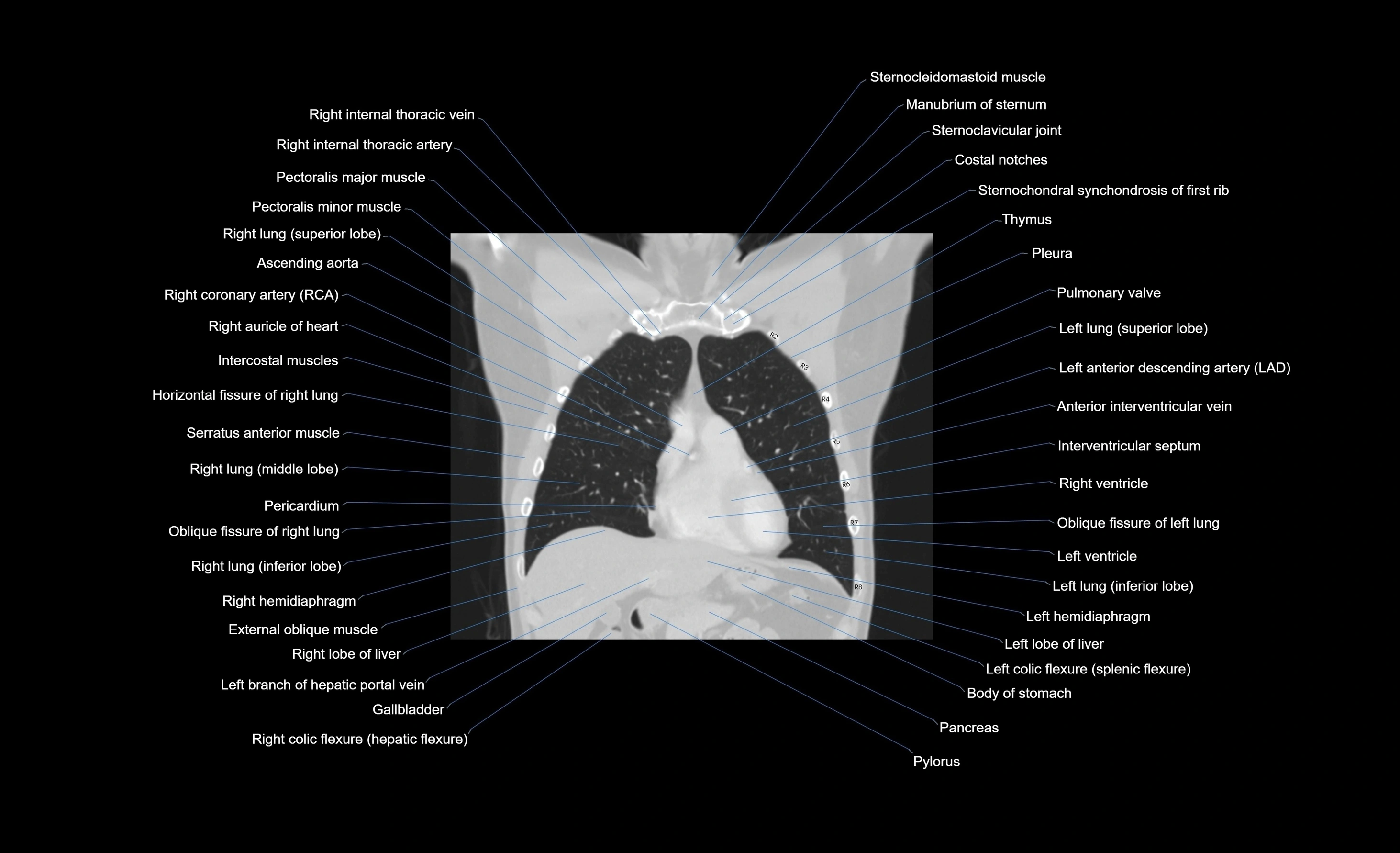 CT chest (thorax) lung window window labelled coronal cross sectional anatomy radiology image-00084.webp